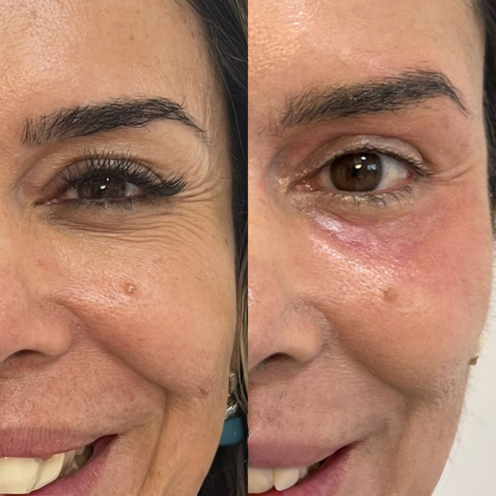 Lumeris Dermalight | The Anti-Wrinkles EMS Eye Mask