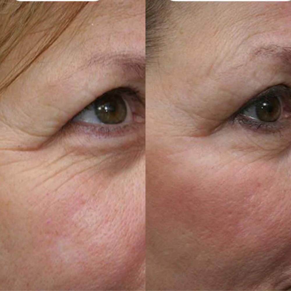 Lumeris Dermalight | The Anti-Wrinkles EMS Eye Mask