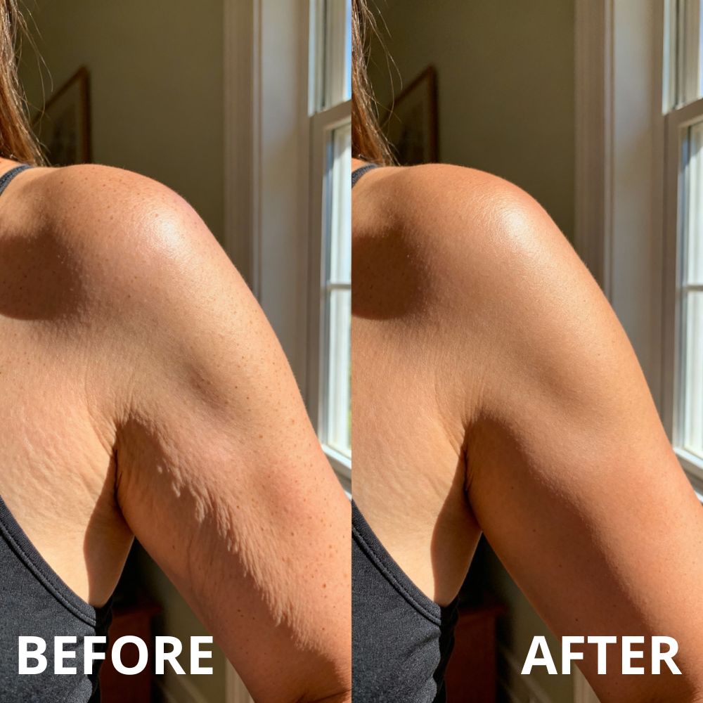Lumeris Arm Bands | Dermalight Lymphatic Therapy