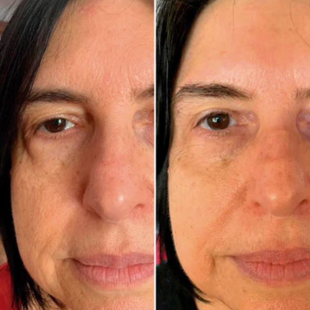 Lumeris Dermalight | The Anti-Wrinkles EMS Eye Mask