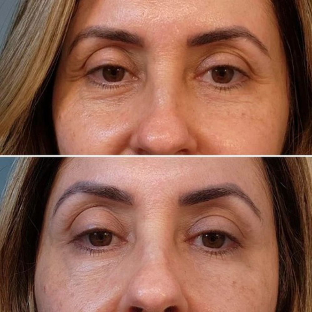 Lumeris Dermalight | The Anti-Wrinkles EMS Eye Mask