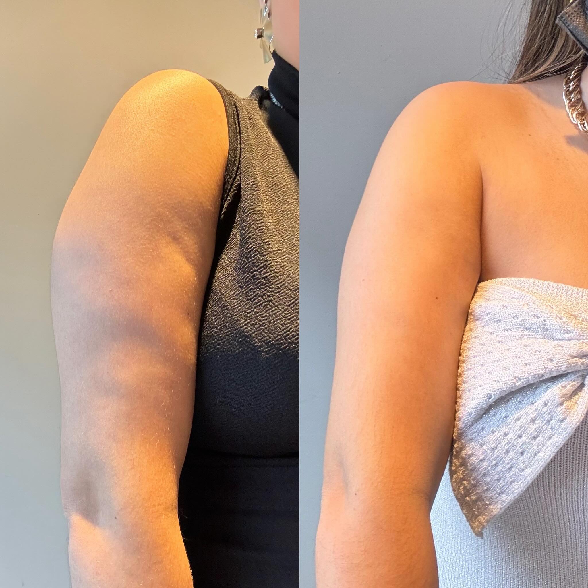 Lumeris Arm Bands | Dermalight Lymphatic Therapy