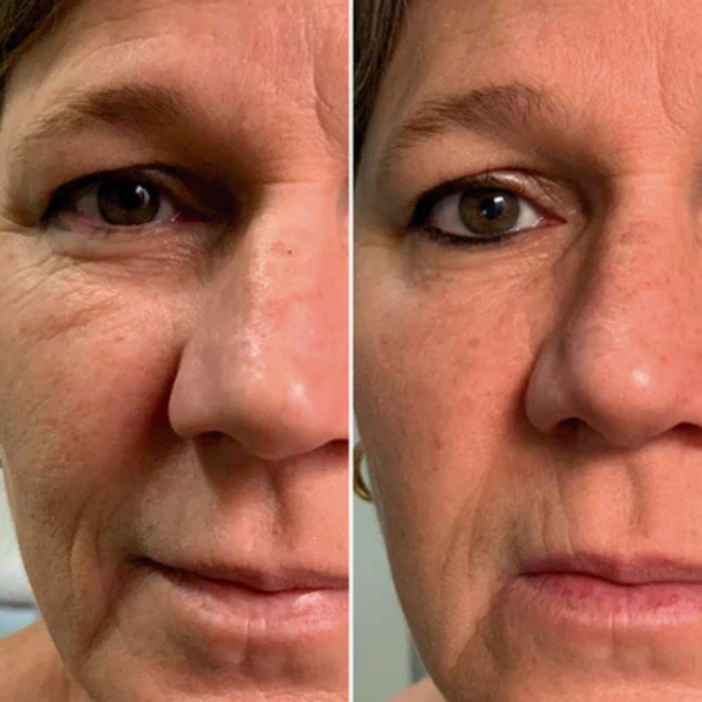 Lumeris Dermalight | The Anti-Wrinkles EMS Eye Mask