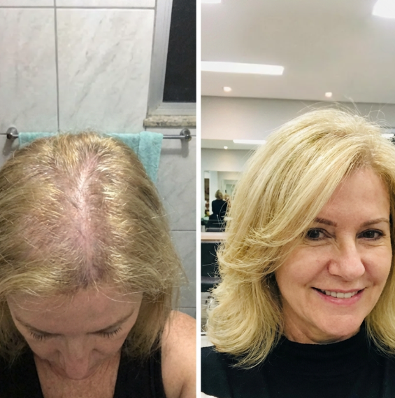 Lumeris Red Light Therapy Cap